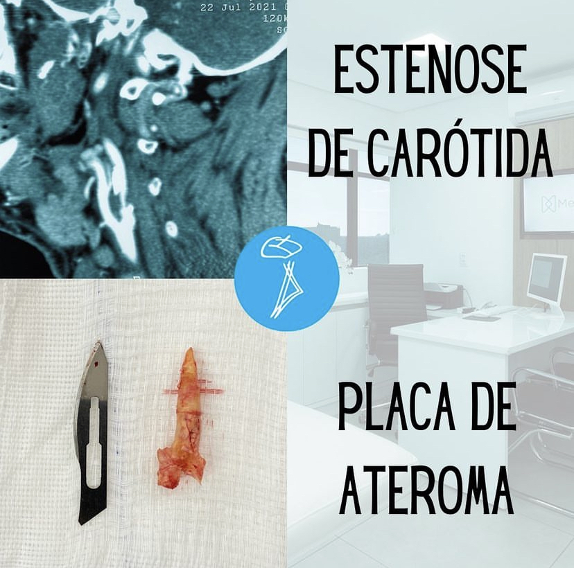 Estenose carotídea: o papel do Neurocirurgião no AVC