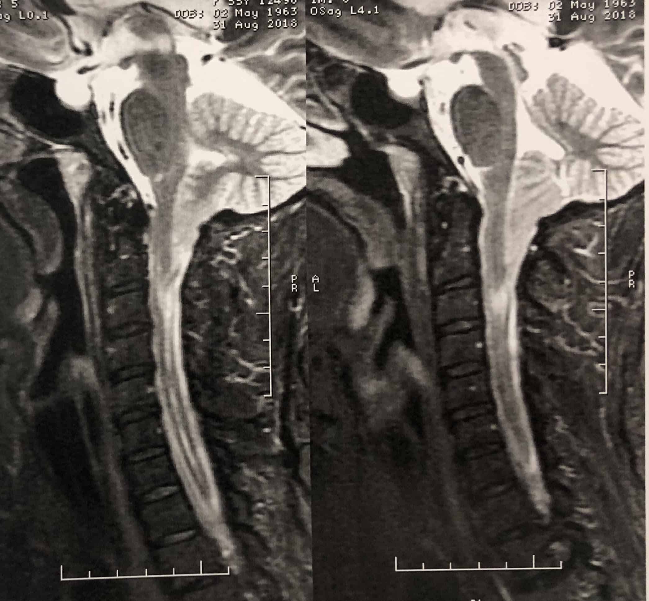 Malformação de Chiari