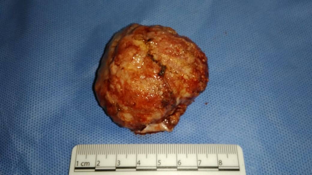 Meningioma