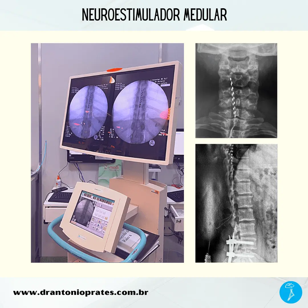 Neuroestimulador medular